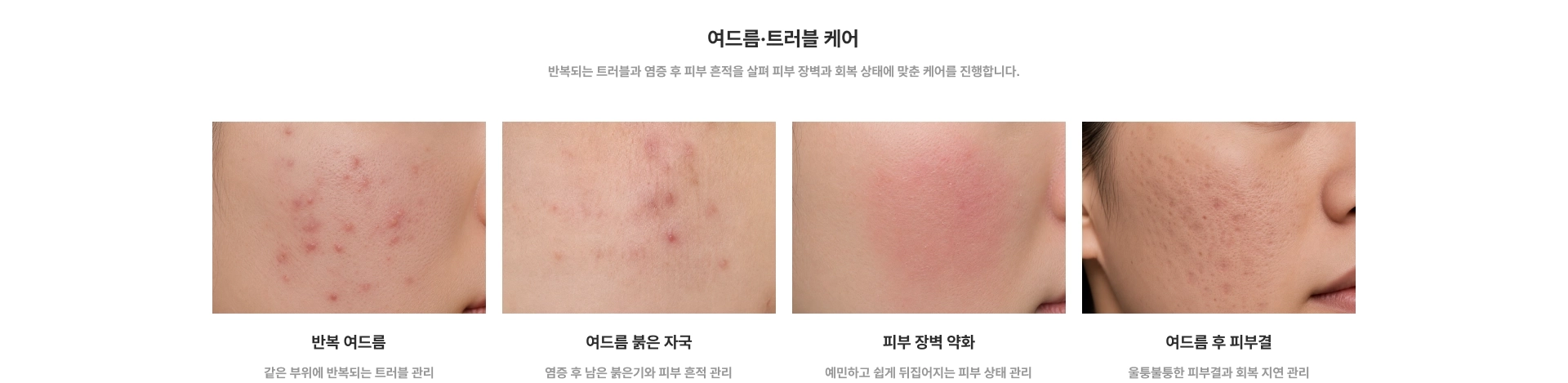 여드름·트러블 케어 : 반복 여드름, 여드름 붉은 자국, 피부 장벽 약화, 여드름 후 피부결
